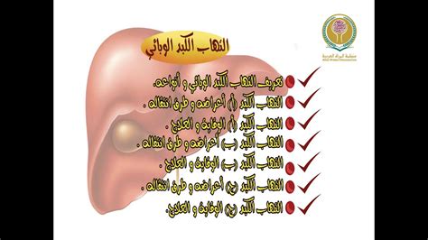 معلومات مهمه عن هذا المرض مرض الكبد الوبائي المميز