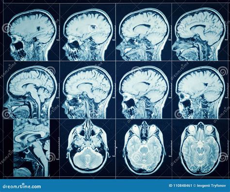 Closeup Of A Ct Scan With Brain Stock Image Image Of Human Mind