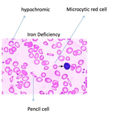 Anaemia Blood Smears Flashcards Quizlet