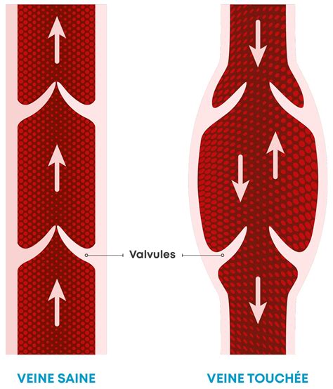 Insuffisance Veineuse Causes Sympt Mes Et Traitements Orliman