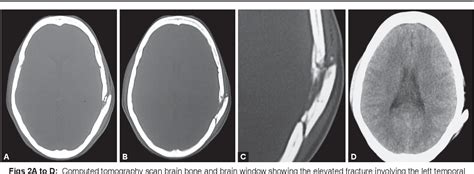 Figure 1 From Elevated Skull Fracture Semantic Scholar