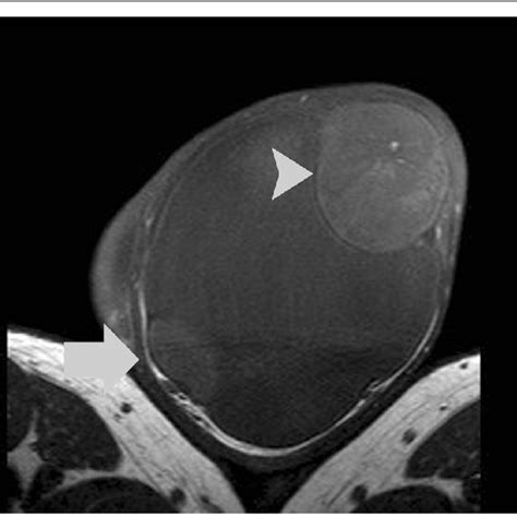 Transverse T2 Weighted Image Demonstrates Left Paratesticular Tumor