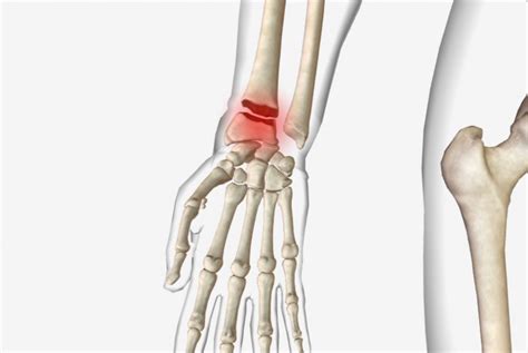 Distal Radius Fracture - Home