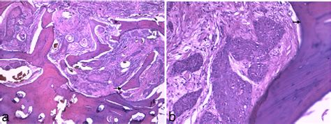 Figure 3 From Primary Intraosseous Squamous Cell Carcinoma Of The