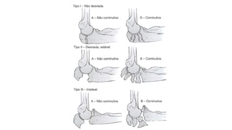 Fratura Do Olecrano O Que Quais Os Tipos Medicina Ortop Dica