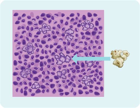 B Nlphl Lymphoma Australia