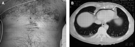 Pneumopericardium Following Stab Wound Emergency Medicine Journal