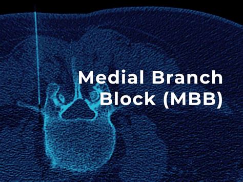 Medial Branch Block CT Guided Injections Patient Fact Sheet