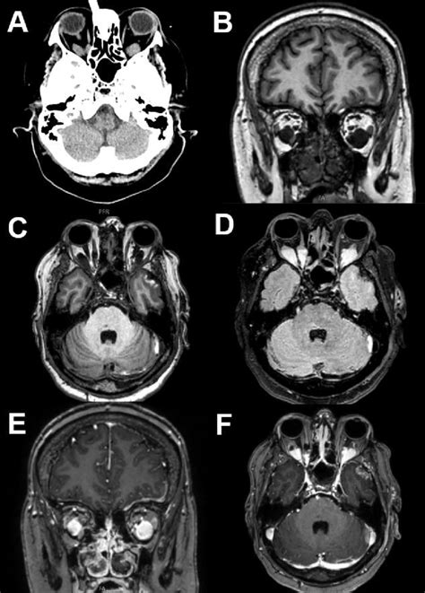 Venous Varices Ct And Mri Of A Patient With Bilateral Orbital Venous