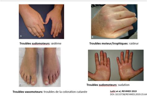 Algoneurodystrophie Sdrc Syndrome Douloureux R Gional Complexe