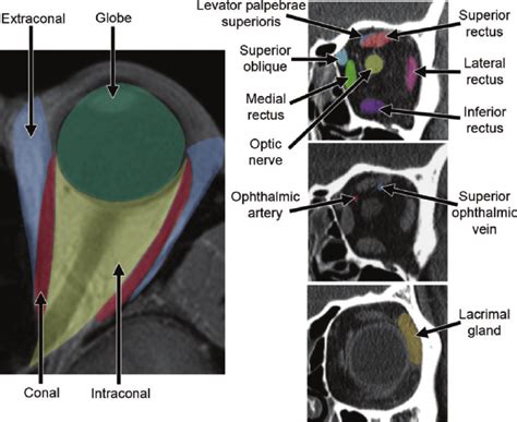 Normal Orbital Anatomy Axial Computed Tomographic Ct Image Left