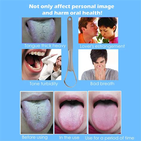 CENGZISHU J Roller Adult Tongue Tongue Coating Scraper Oral Care Tongue Cleaning Scraper Tongue ...