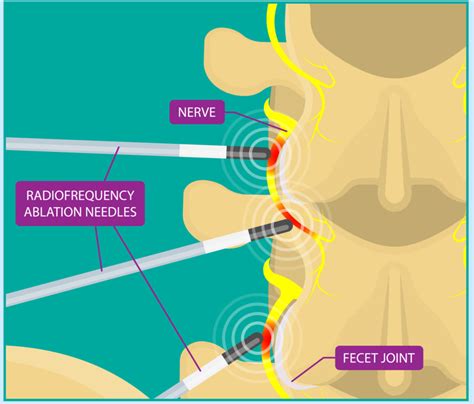 Treatments Shore Spine Pain