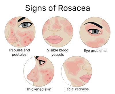 Battling Rosacea | Garza Plastic Surgery | Belle Meade, TN