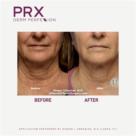 PRX Derm Perfexion | INTERLOCKS Salon & MedSpa | Newburyport MA