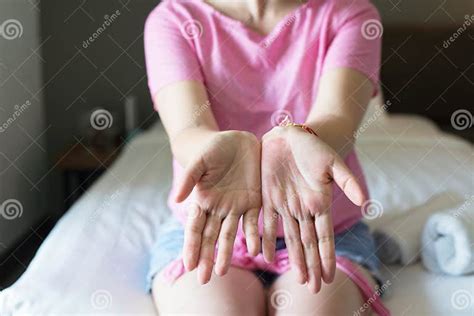 Hands Female With Rash Or Papule And Scratchon Palm On From Allergies