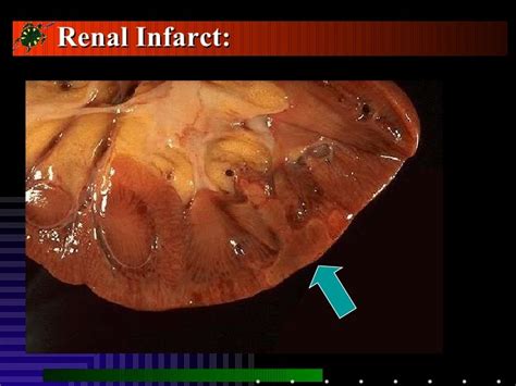 Pathology Of Kidney