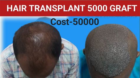 Low Cost Hair Transplant Hair Transplant In India Graft Hair