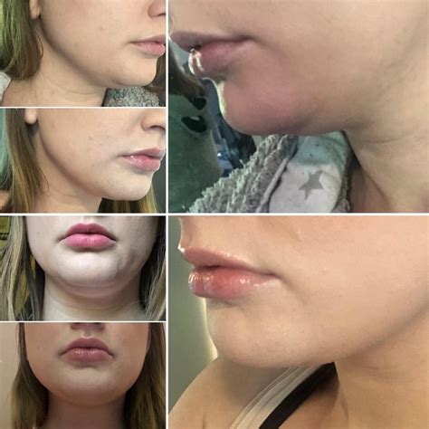 Coolsculpting Mini For Double Chin Before And After 3 Week Progress I Know This Procedure Is