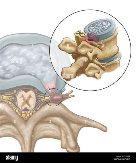 Disk Herniation Hi Res Stock Photography And Images Alamy