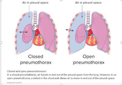 Module Pneumothorax Empyema Chest Tubes Flashcards Quizlet