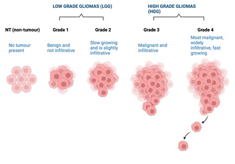 An illustration of Glioma Grades and their typical characteristics ...