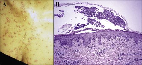 Acute Generalized Exanthematous Pustulosis Histology