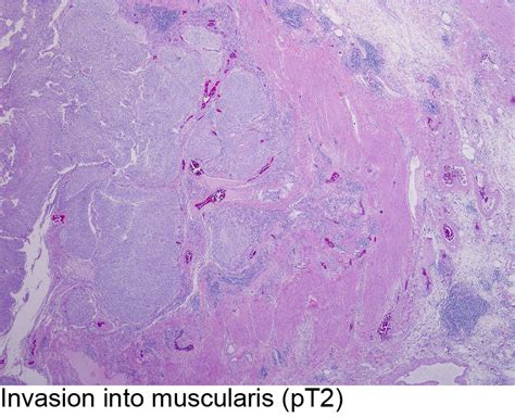 Pathology Outlines Invasive Urothelial Carcinoma