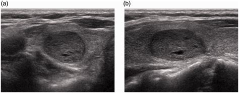 Medullary Carcinoma Thyroid Ultrasound