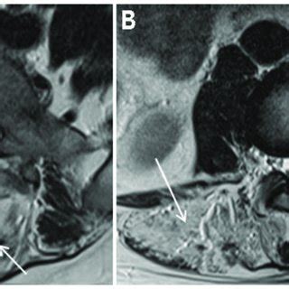 Magnetic resonance image (MRI) of the lumbar spine. (A) L5-S1 disc ...