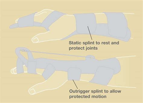 Finger Joint Replacement – Richard Stephen Gilbert, M.D.