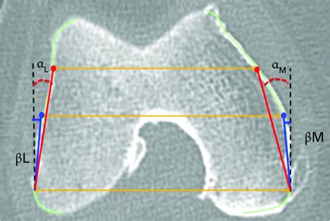 Morphometric Analysis Of The Distal Femur In Total Knee Arthroplasty