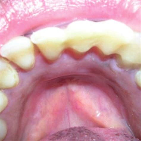 (PDF) 46. Periodontal Splinting