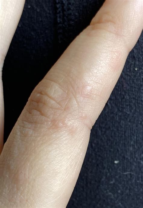 Weird Bumps On Finger R Psoriasis