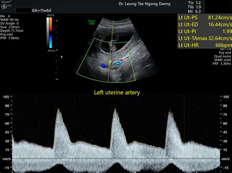 Pre Eclampsia Hkog Info