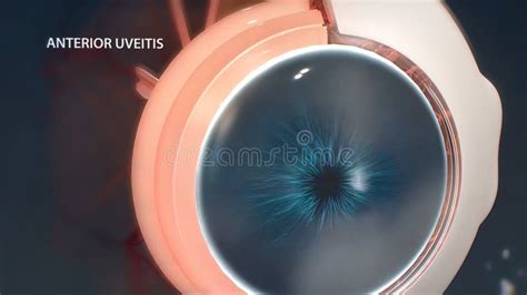 Uveitis is the Inflammation of Part or All of the Uvea in the Eye. it ...