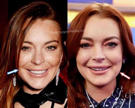 Lindsay Lohan Before And After 2022