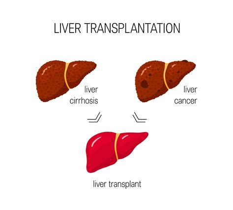 Understanding The Necessity Of Liver Transplantation By Dr Vineet