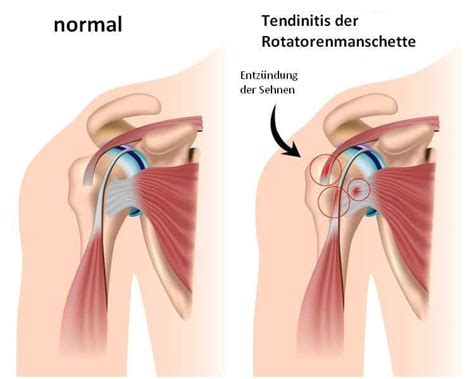 Entzündung Supraspinatussehne Schulter Bursitis Symptome Übungen