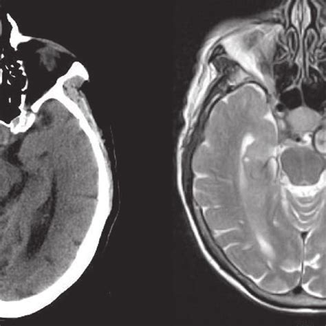 Coronal views of head CT (left) and MRI T1 with contrast (right ...