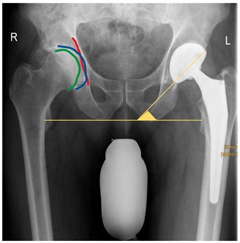 Jcm Free Full Text The Direct Anterior Approach Daa As A Standard