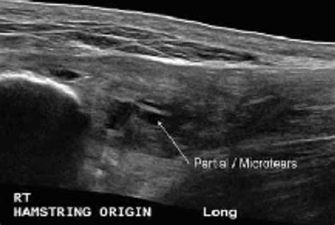 HIP & GROIN - Advanced - Physicians of Sports & Orthopedic Medicine