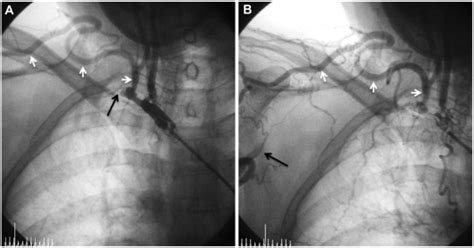 Angiography Of The Right Subclavian Artery Show Total Occlusion Black