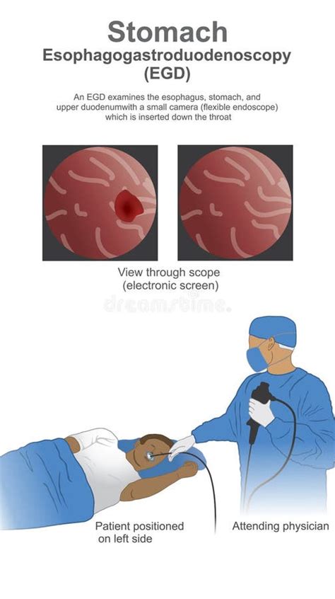 Esophagogastroduodenoscopy Egd Is A Test To Examine The Lining O Stock