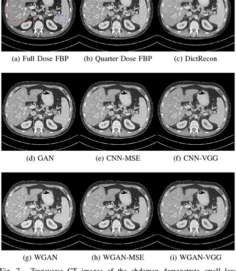 Figure 1 From Low Dose Ct Image Denoising Using A Generative