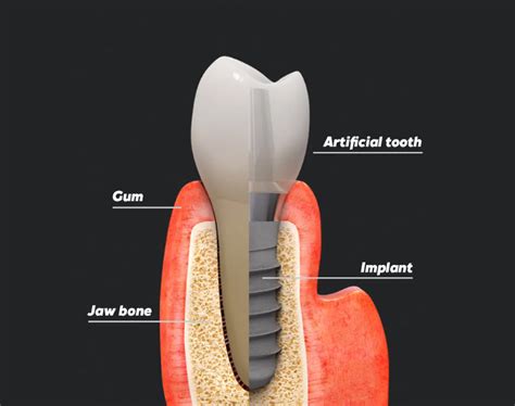 Dental Implants Restore Your Smile With Expert Care