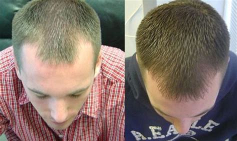 Laser Hair Growth Treatment (LLLT): Does it Work? - Bald & Beards