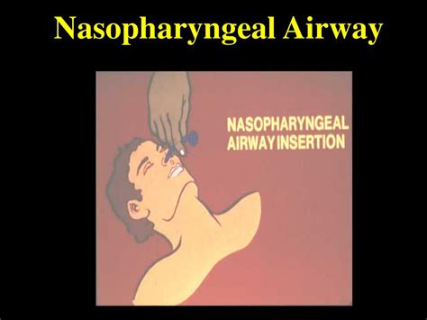 Ppt Airway Management Powerpoint Presentation Free Download Id6720547