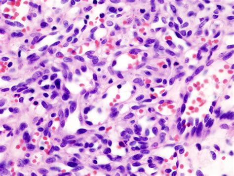 Pathology Outlines Hemangioma