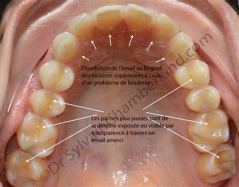 Boissons Gazeuses érosion Dentaireorthodontiste à Québecchamberland